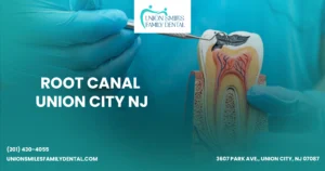 Root Canal Union City NJ