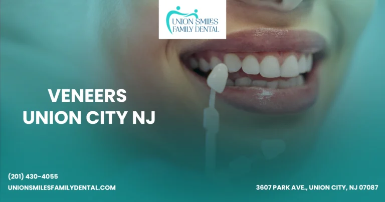 Veneers Union City NJ